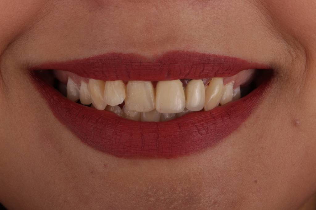 1.1before-1024x683